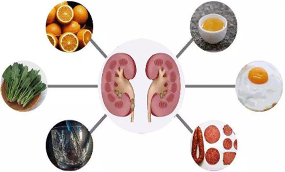 怎樣預(yù)防腎結(jié)石的發(fā)生